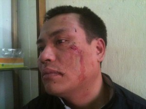Nguyen Chi Duc displays his wounded face following an ambush by unidentified assailants, April 9, 2013. Photo courtesy of Blog Teu